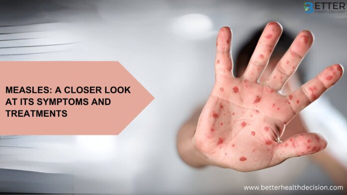 Measles: A Closer Look At Its Symptoms And Treatments